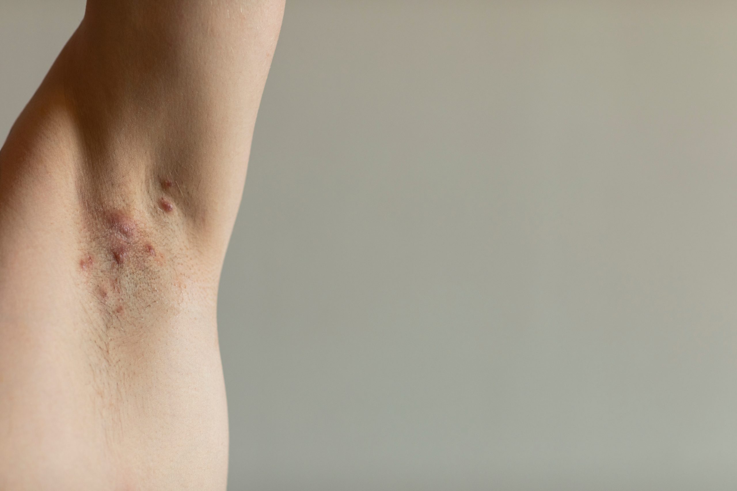 A patient diagnosed with Crohn’s disease with hidradenitis sup A patient diagnosed with Crohn’s disease with hidradenitis suppurativa under his armit with visible red painful fistulas. Irritated skin and hair follicles, abcess. Close up